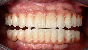 kasus perusahaan terbaru tentang Kasus Pelanggan. Blok Zirconia 4D