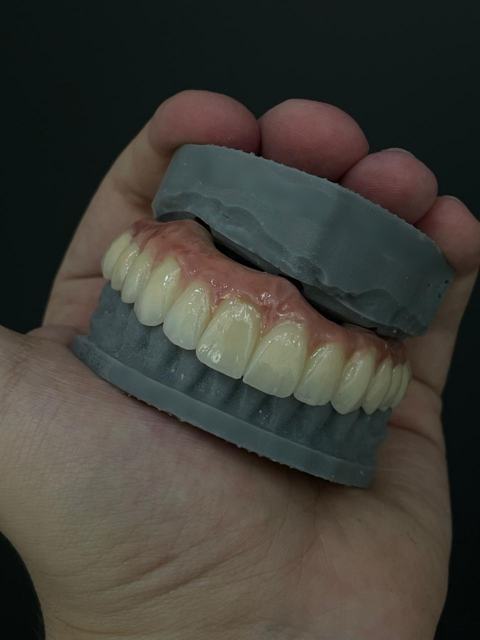 kasus perusahaan terbaru tentang Mencapai Estetika Alami dengan Zirkonia: Kasus Restorasi Lengkungan Penuh yang Berhasil dari Brasil